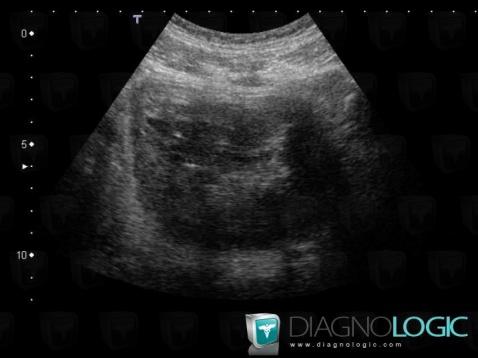 Bladder transitional cell carcinoma, Urinary bladder, US