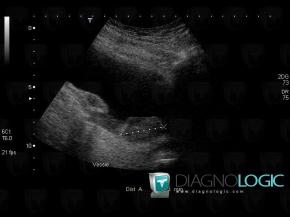 Bladder transitional cell carcinoma, Urinary bladder, US