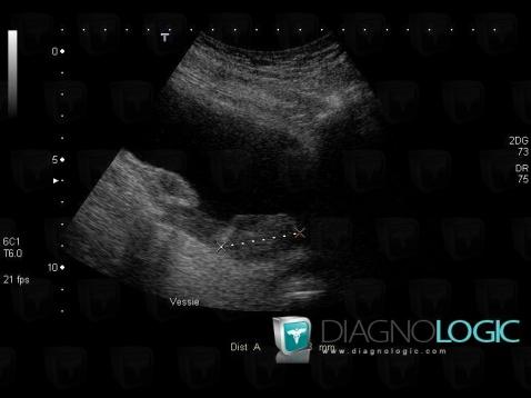 Bladder transitional cell carcinoma, Urinary bladder, US