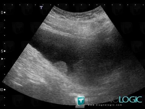 Bladder transitional cell carcinoma, Urinary bladder, US