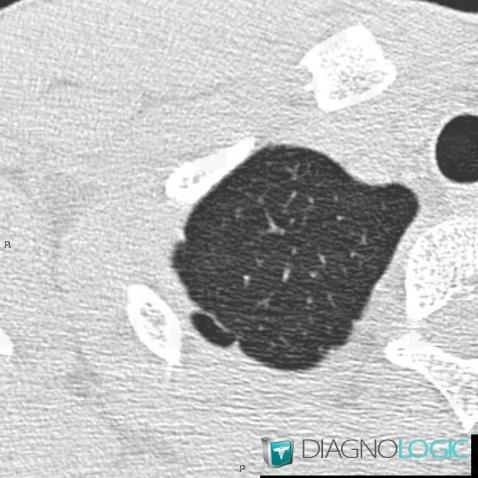 Bleb, Parenchyme pulmonaire, Scanner
