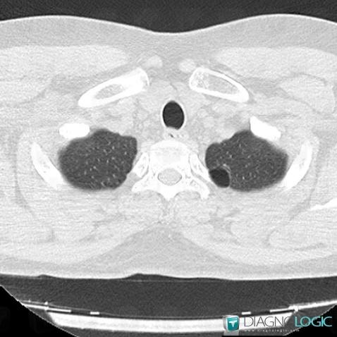 Bleb, Pulmonary parenchyma, CT