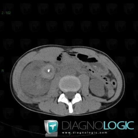 Blood clot, Collecting system, CT