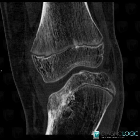 Blount's disease, Tibia - Proximal part, CT