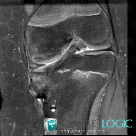 Blount's disease, Tibia - Proximal part, MRI