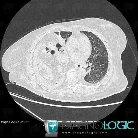 Bochdalek hernia, Diaphragm, CT