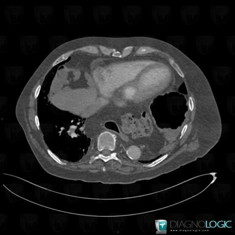 Bochdalek hernia, Mediastinum, CT