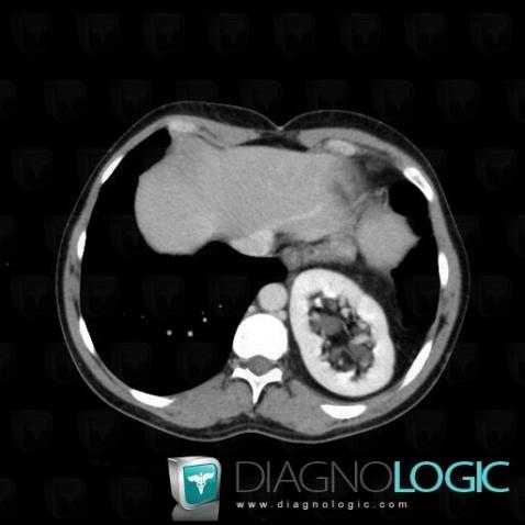 Bochdalek hernia, Mediastinum, CT