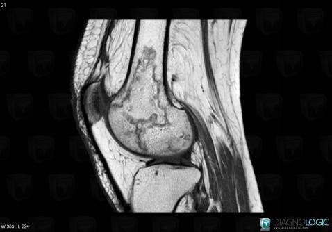 Bone infarct, Femur - Distal part, MRI