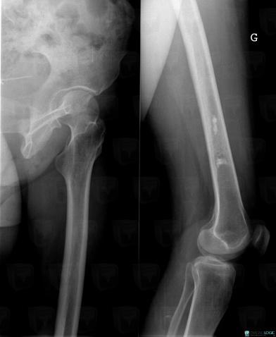 Bone infarct, Femur - Distal part, X rays