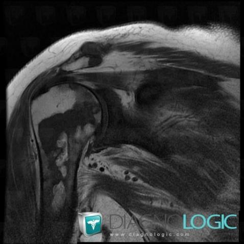 Bone infarct, Humerus - Proximal part, MRI