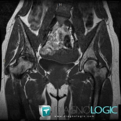 Bone infarct, Ilium, MRI