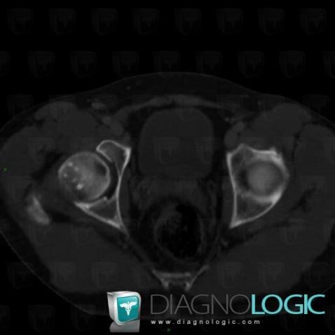 Bone island, Femur - Proximal part, CT