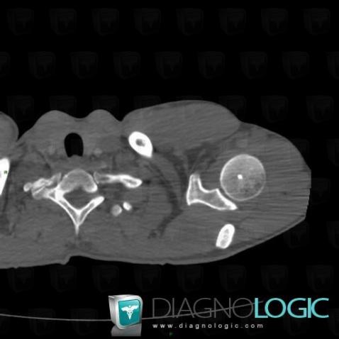 Bone island, Humerus - Proximal part, CT