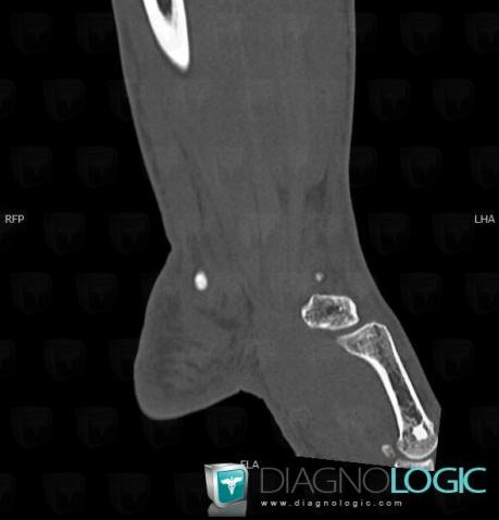 Bone island, Metacarpal bones, CT