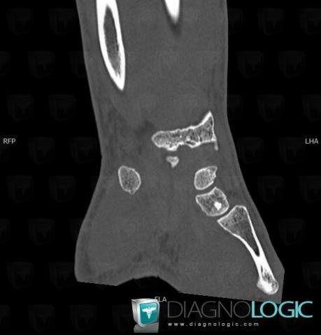 Bone island, Other carpal bones, CT