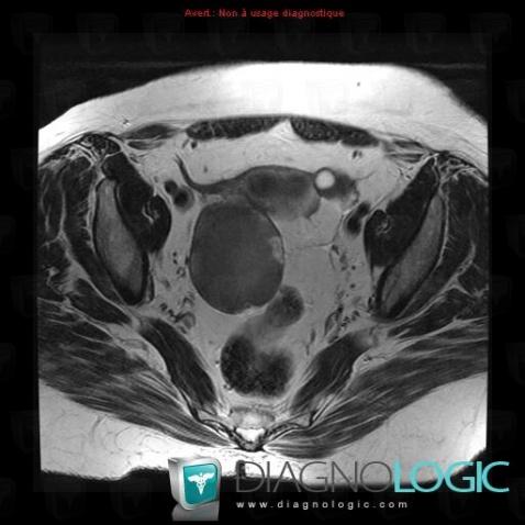 Borderline ovarian tumor, Adnexa / Ovary fallopian tube, MRI