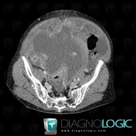 Borderline ovarian tumor, Adnexa / Ovary fallopian tube, Pelvis / Perineum, CT