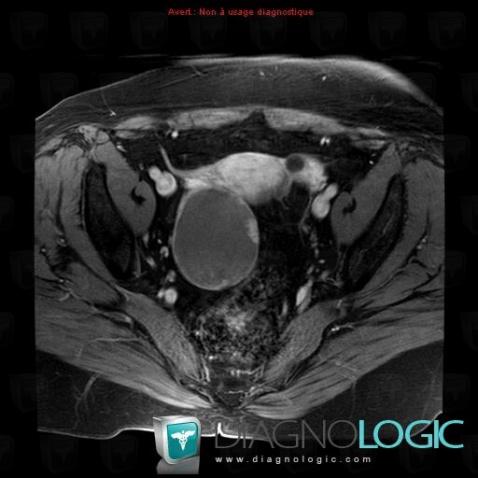 Borderline ovarian tumor, Adnexa / Ovary fallopian tube, Pelvis / Perineum, MRI