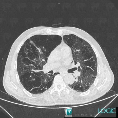 BPCO, Parenchyme pulmonaire, Scanner