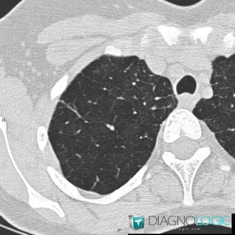 BPCO, Parenchyme pulmonaire, Scanner