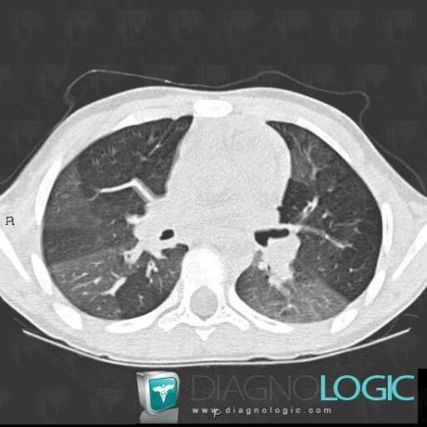 BPCO, Parenchyme pulmonaire, Voies aériennes, Scanner