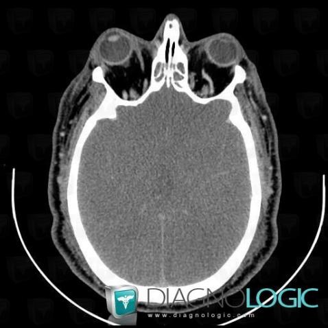 Brain death, Cerebral hemispheres, CT