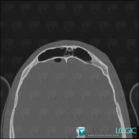 Brèche ostéo-durale, Sinus, Scanner