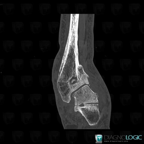 Brodie abscess, Tibia - Distal part, CT