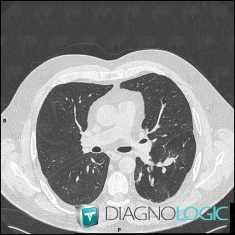 Bronchial atresia, Airways, CT