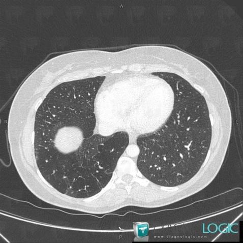 Bronchial atresia, Airways, CT