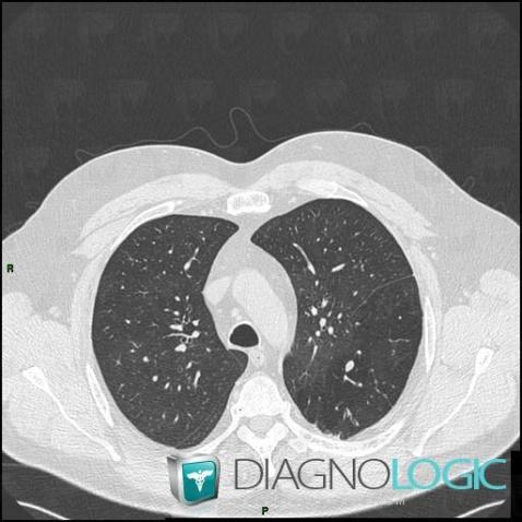 Bronchial atresia, Pulmonary parenchyma, Airways, CT