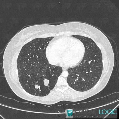 Bronchial atresia, Pulmonary parenchyma, Airways, CT