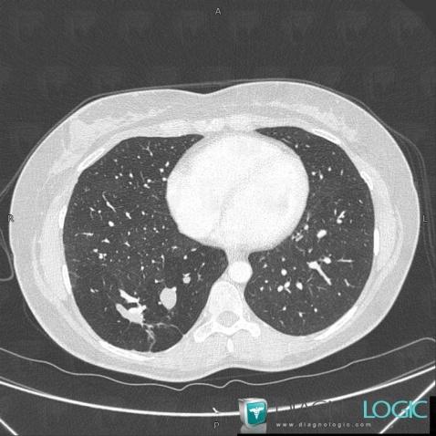 Bronchial atresia, Pulmonary parenchyma, CT