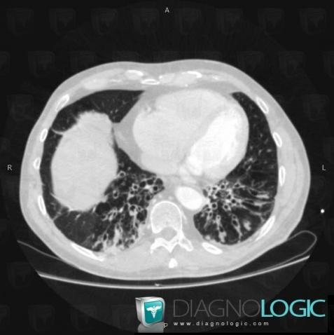 Bronchiectasis, Pulmonary parenchyma, Airways, CT