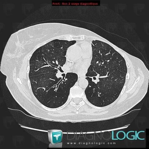 Bronchiolite oblitérante, Parenchyme pulmonaire, Voies aériennes, Scanner