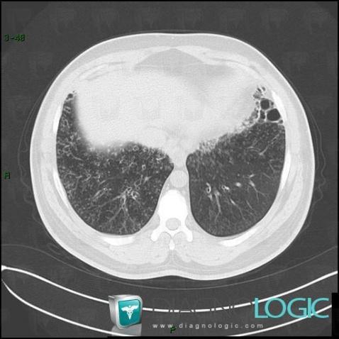 Bronchiolitis, Pulmonary parenchyma, CT