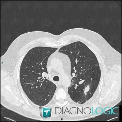 Bronchioloalveolar carcinoma, Pulmonary parenchyma, CT