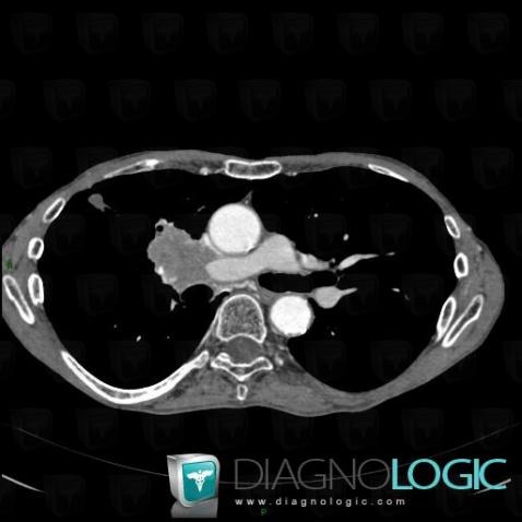 Bronchogenic carcinoma, Mediastinum, CT