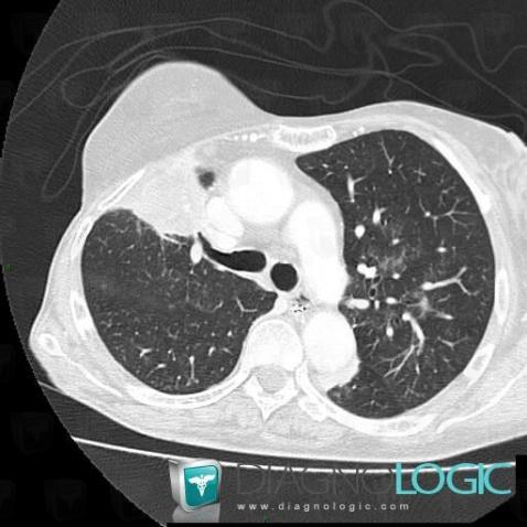 Bronchogenic carcinoma, Pulmonary parenchyma, CT