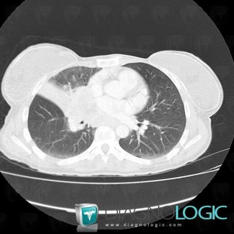 Bronchogenic carcinoma, Pulmonary parenchyma, CT