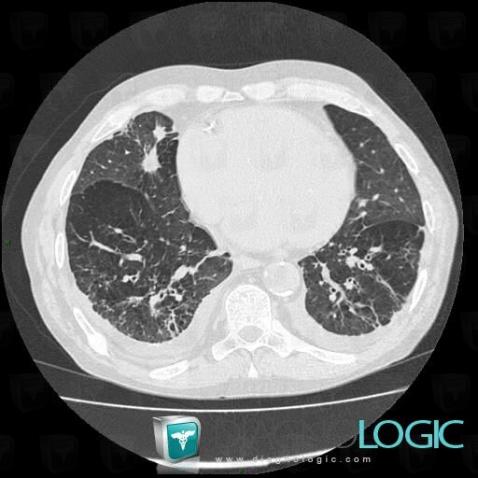 Bronchogenic carcinoma, Pulmonary parenchyma, CT