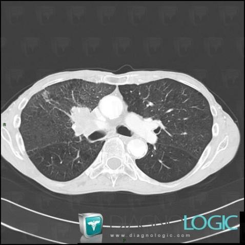 Bronchogenic carcinoma, Pulmonary parenchyma, CT