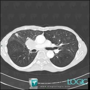 Bronchogenic carcinoma, Pulmonary parenchyma, CT