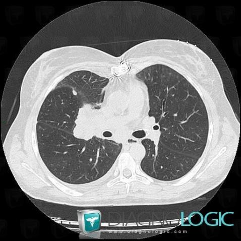 Bronchogenic carcinoma, Pulmonary parenchyma, CT