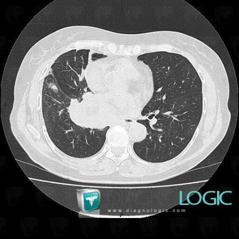 Bronchogenic carcinoma, Pulmonary parenchyma, CT