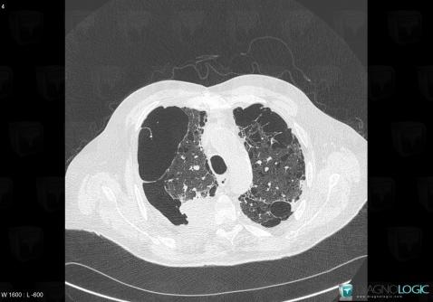 Bronchogenic carcinoma, Pulmonary parenchyma, CT