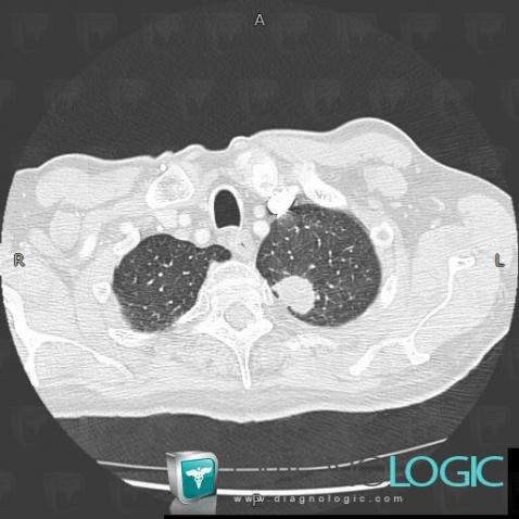 Bronchogenic carcinoma, Pulmonary parenchyma, CT