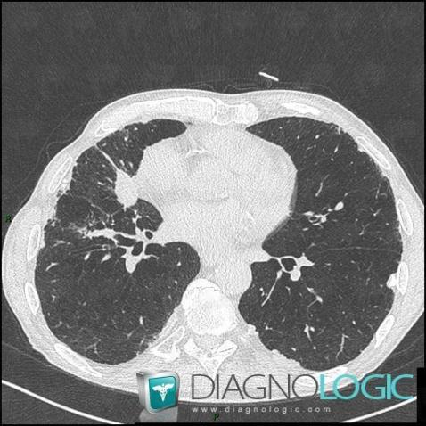 Bronchogenic carcinoma, Pulmonary parenchyma, CT