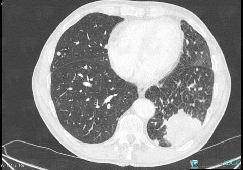 Bronchogenic carcinoma, Pulmonary parenchyma, CT